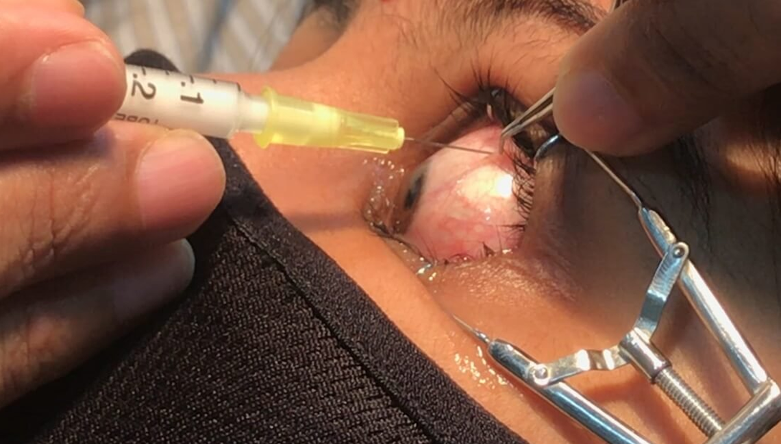 Intravitreal Injections